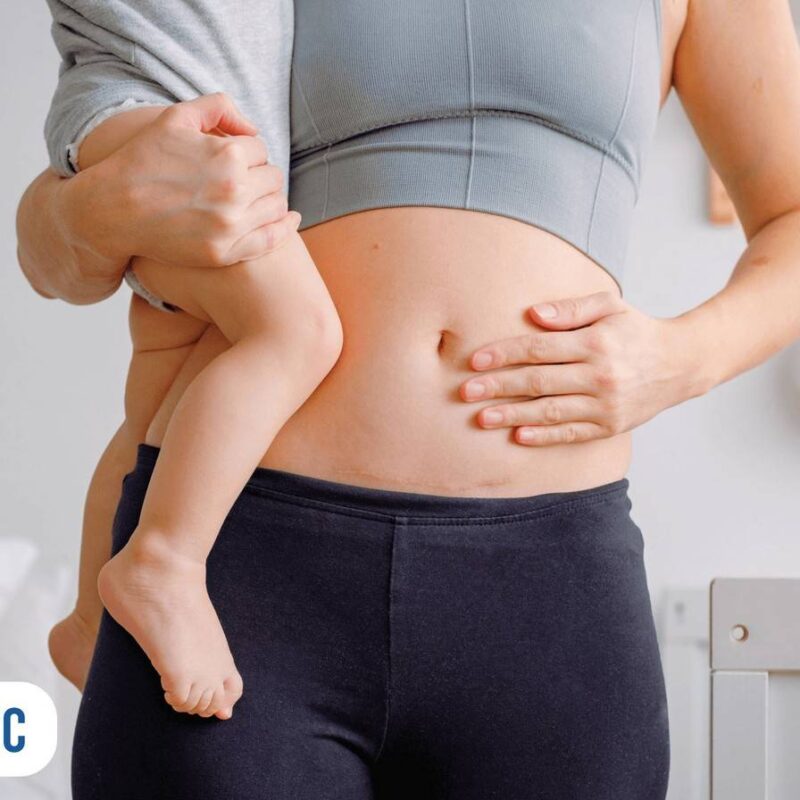 Mulher com bebê no colo com cicatriz de cesárea