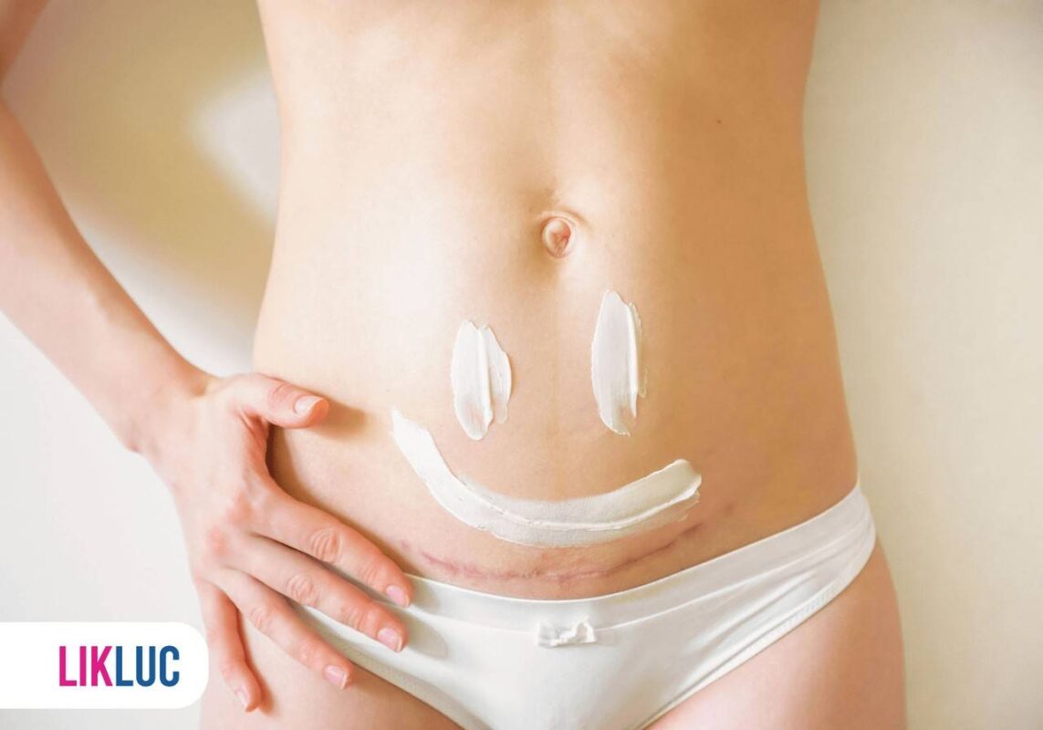 Mulher com cicatriz de cesárea com creme com desenho de carinha