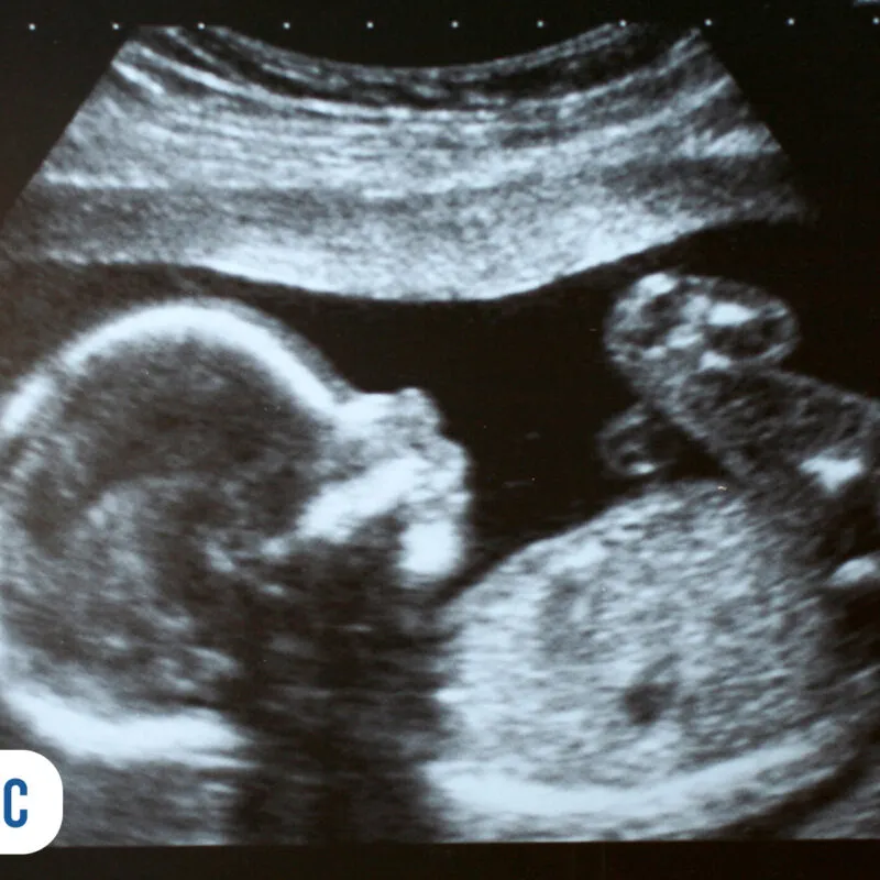 Ultrassom de bebê em desenvolvimento