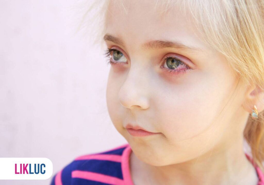 Detalhe de rosto de criança com olhos vermelhos e lacrimejando