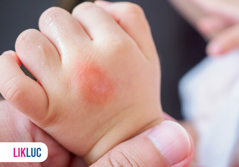 Mão de bebê com irritação na pele visível