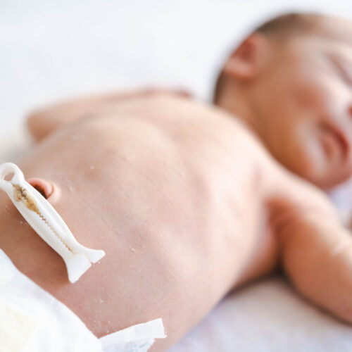 Recém-nascido com curativo no umbigo