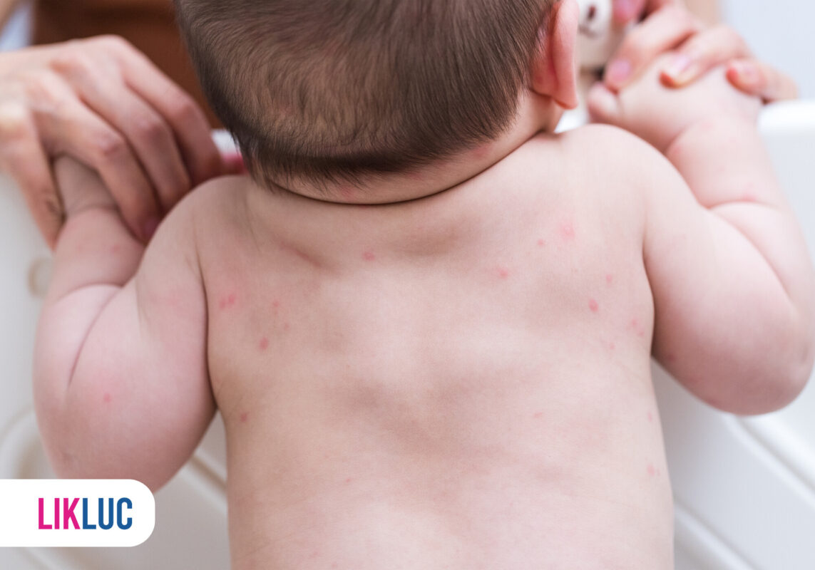 Costas de um bebê com erupções cutâneas visíveis.