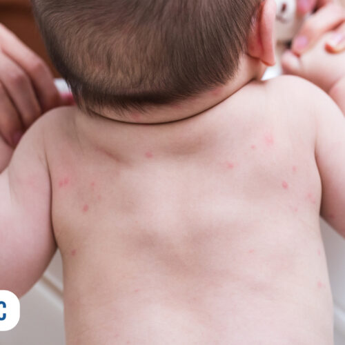 Costas de um bebê com erupções cutâneas visíveis.