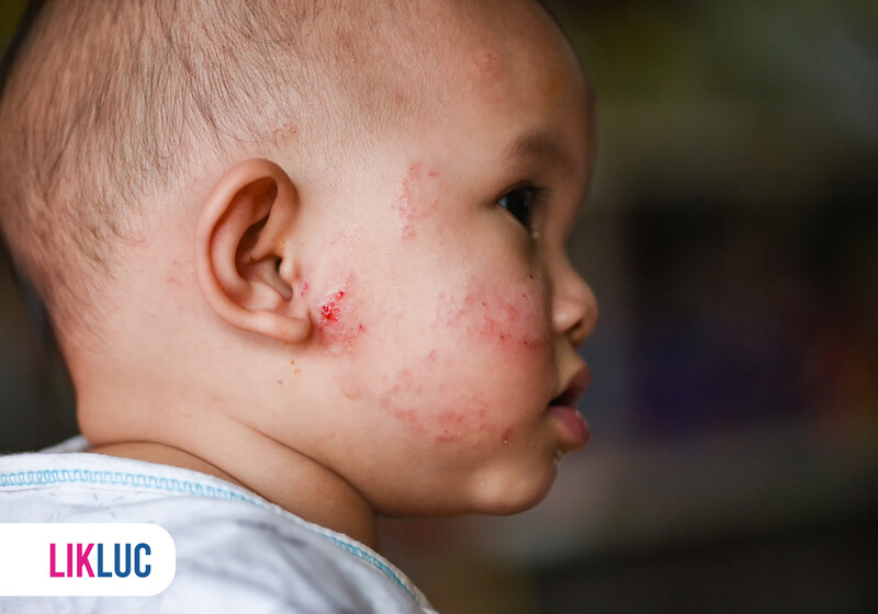 Criança com irritação facial e feridas aparentes.