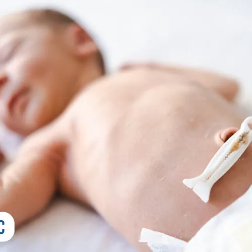 Recém-nascido com clampeador umbilical na barriga