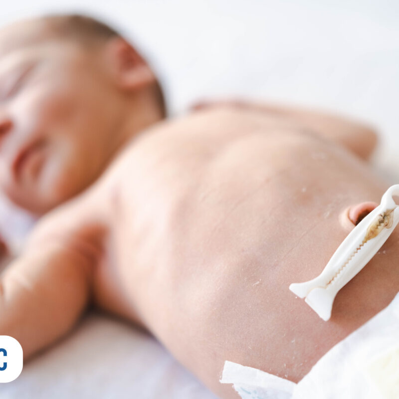 Recém-nascido com clampeador umbilical na barriga