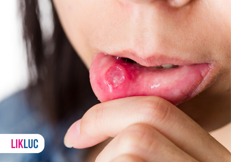 Lesão na mucosa bucal em pessoa