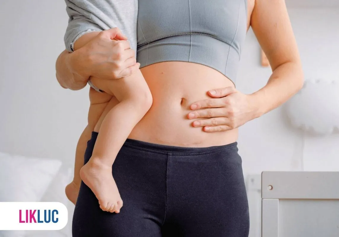 Mulher com bebê no colo com cicatriz de cesárea