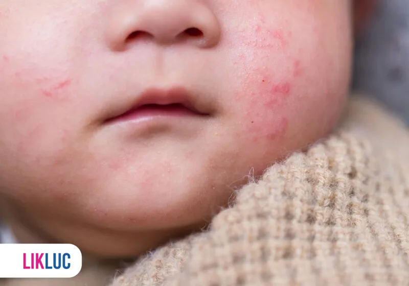 Bebê com irritação na pele e expressão suave.